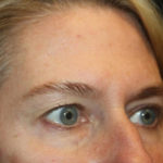 Blepharoplasty and Brow Lift Before & After Patient #25392