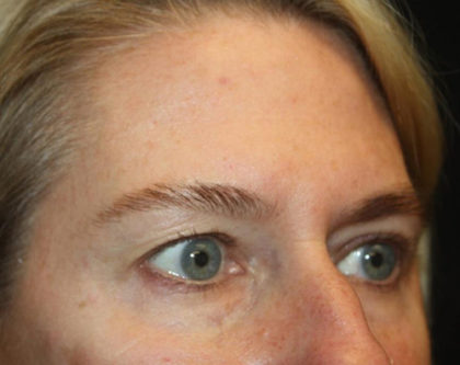 Blepharoplasty and Brow Lift Before & After Patient #25392