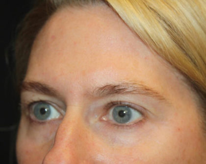 Blepharoplasty and Brow Lift Before & After Patient #25392