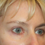 Blepharoplasty and Brow Lift Before & After Patient #25392