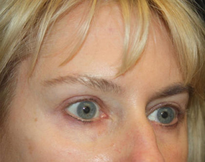 Blepharoplasty and Brow Lift Before & After Patient #25392