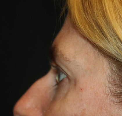 Blepharoplasty and Brow Lift Before & After Patient #25392