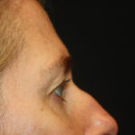 Blepharoplasty and Brow Lift Before & After Patient #25392