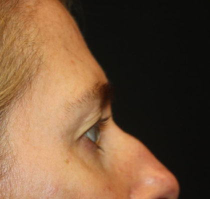 Blepharoplasty and Brow Lift Before & After Patient #25392