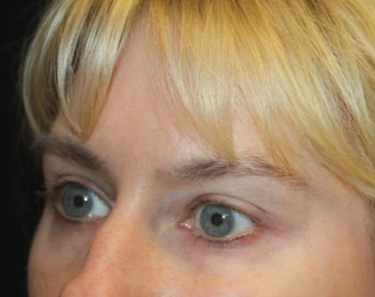 Blepharoplasty and Brow Lift Before & After Patient #25392