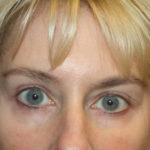 Blepharoplasty and Brow Lift Before & After Patient #25392