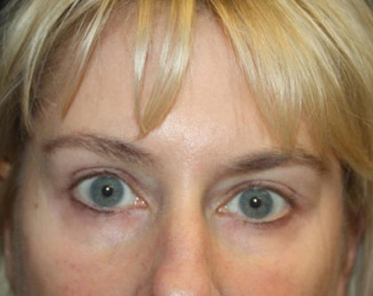 Blepharoplasty and Brow Lift Before & After Patient #25392