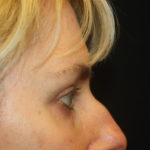 Blepharoplasty and Brow Lift Before & After Patient #25392