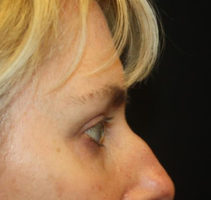 Blepharoplasty and Brow Lift Before & After Patient #25392