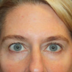 Blepharoplasty and Brow Lift Before & After Patient #25392