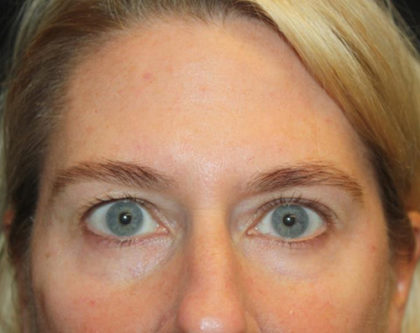 Blepharoplasty and Brow Lift Before & After Patient #25392