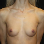 Breast Augmentation - Round Silicone Implants Before & After Patient #25575