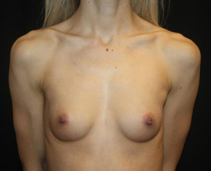 Breast Augmentation - Round Silicone Implants Before & After Patient #25575