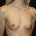 Breast Augmentation - Round Silicone Implants Before & After Patient #25575