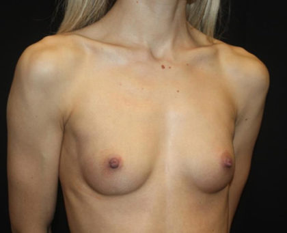 Breast Augmentation - Round Silicone Implants Before & After Patient #25575