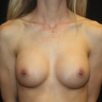 Breast Augmentation - Round Silicone Implants Before & After Patient #25575