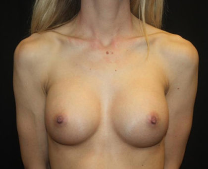 Breast Augmentation - Round Silicone Implants Before & After Patient #25575