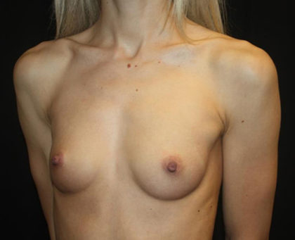 Breast Augmentation - Round Silicone Implants Before & After Patient #25575