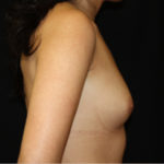 Breast Augmentation - Saline Implants Before & After Patient #26516