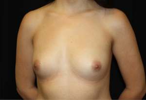 Breast Augmentation - Saline Implants Before & After Patient #26516
