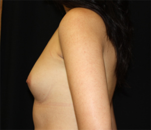 Breast Augmentation - Saline Implants Before & After Patient #26516