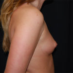 Breast Augmentation - Shaped Silicone Implants Before & After Patient #26428