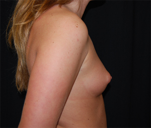Breast Augmentation - Shaped Silicone Implants Before & After Patient #26428