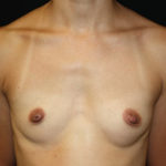 Breast Augmentation - Shaped Silicone Implants Before & After Patient #26439