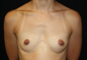 Breast Augmentation - Shaped Silicone Implants Before & After Patient #26439