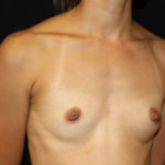 Breast Augmentation - Shaped Silicone Implants Before & After Patient #26439