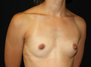 Breast Augmentation - Shaped Silicone Implants Before & After Patient #26439