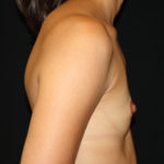 Breast Augmentation - Shaped Silicone Implants Before & After Patient #26439