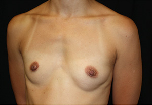 Breast Augmentation - Shaped Silicone Implants Before & After Patient #26439