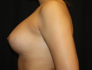 Breast Augmentation - Shaped Silicone Implants Before & After Patient #26450