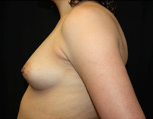 Breast Augmentation - Shaped Silicone Implants Before & After Patient #26461