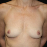 Breast Augmentation - Shaped Silicone Implants Before & After Patient #26472