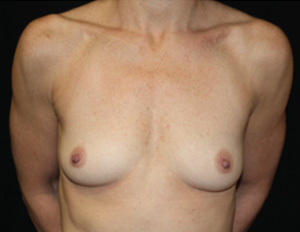 Breast Augmentation - Shaped Silicone Implants Before & After Patient #26472