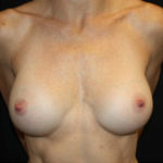 Breast Augmentation - Shaped Silicone Implants Before & After Patient #26472