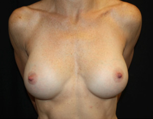 Breast Augmentation - Shaped Silicone Implants Before & After Patient #26472