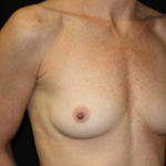 Breast Augmentation - Shaped Silicone Implants Before & After Patient #26472