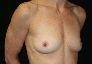 Breast Augmentation - Shaped Silicone Implants Before & After Patient #26472