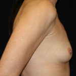 Breast Augmentation - Shaped Silicone Implants Before & After Patient #26472