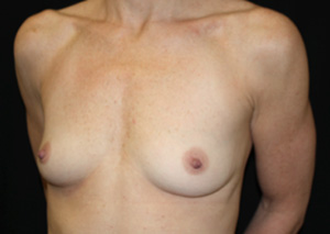 Breast Augmentation - Shaped Silicone Implants Before & After Patient #26472