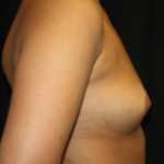 Breast Augmentation - Shaped Silicone Implants Before & After Patient #26483