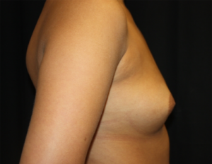 Breast Augmentation - Shaped Silicone Implants Before & After Patient #26483