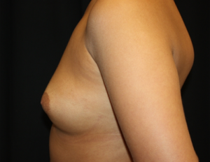 Breast Augmentation - Shaped Silicone Implants Before & After Patient #26483