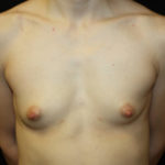 Breast Augmentation - Shaped Silicone Implants Before & After Patient #26494