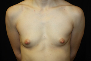 Breast Augmentation - Shaped Silicone Implants Before & After Patient #26494