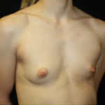 Breast Augmentation - Shaped Silicone Implants Before & After Patient #26494