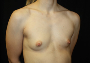 Breast Augmentation - Shaped Silicone Implants Before & After Patient #26494